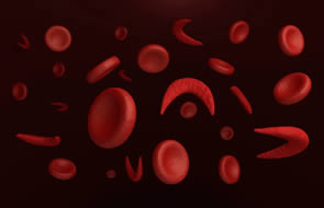 Priapism and Sickle Cell Disease
